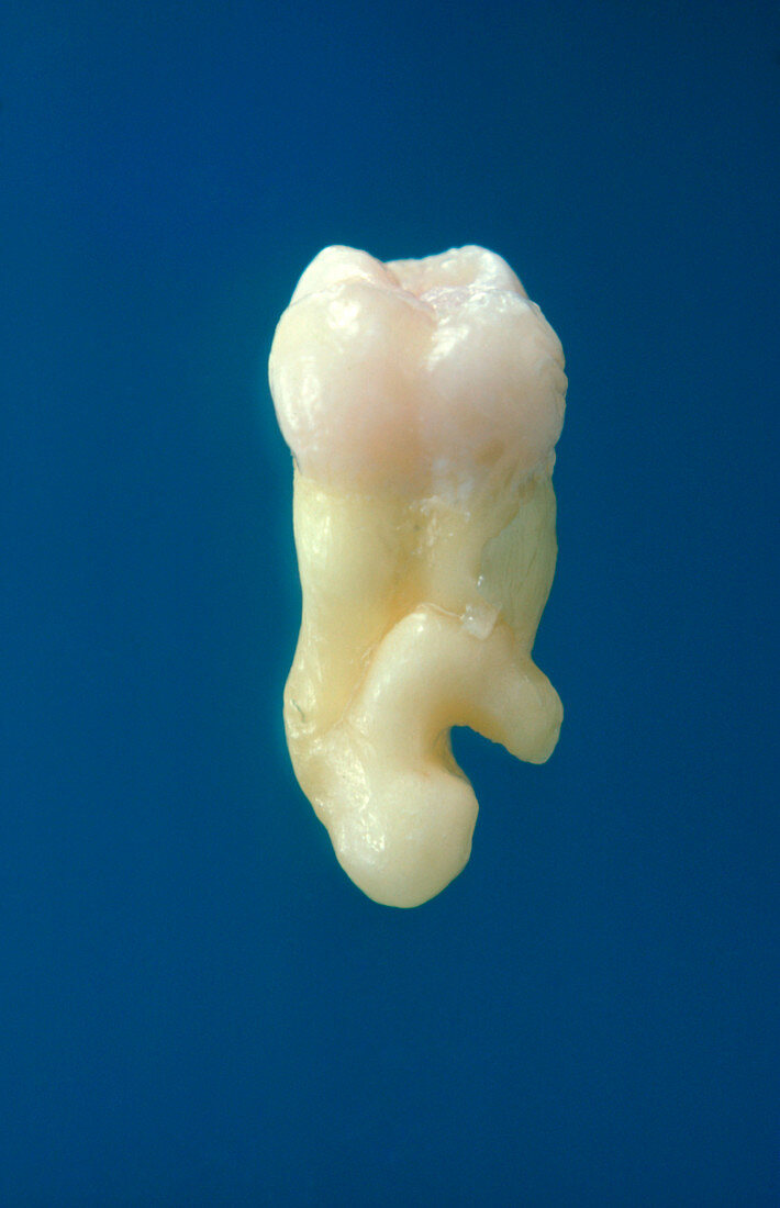 Wisdom tooth with abnormal root