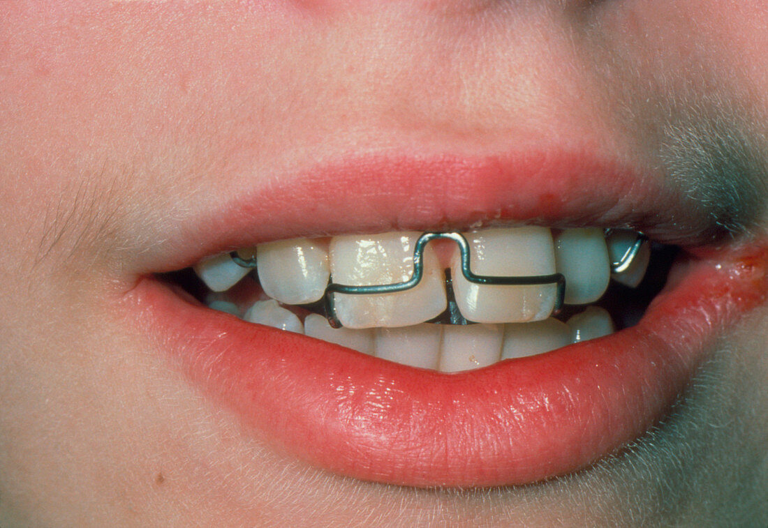 Close-up of child's mouth fitted with dental brace