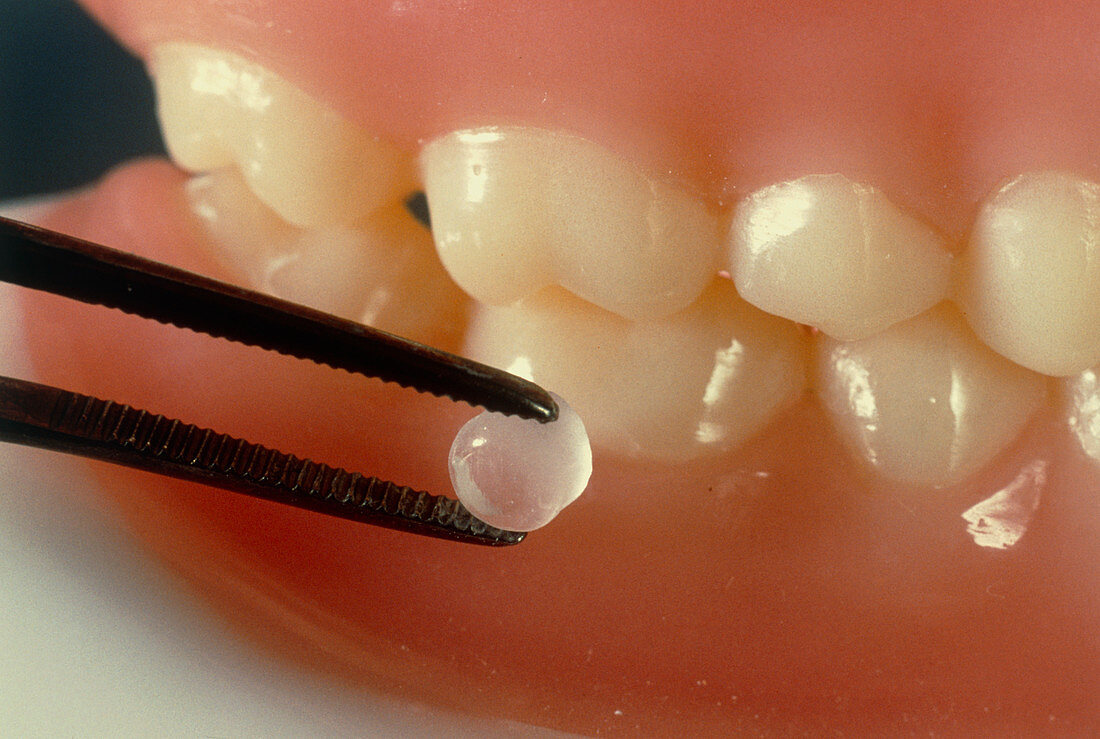 Fluoride tooth implant with a set of model teeth