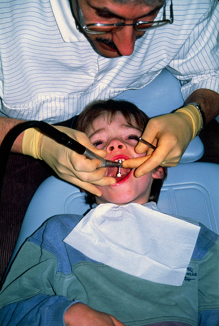 Dentist applying chemical sealant to teeth of boy
