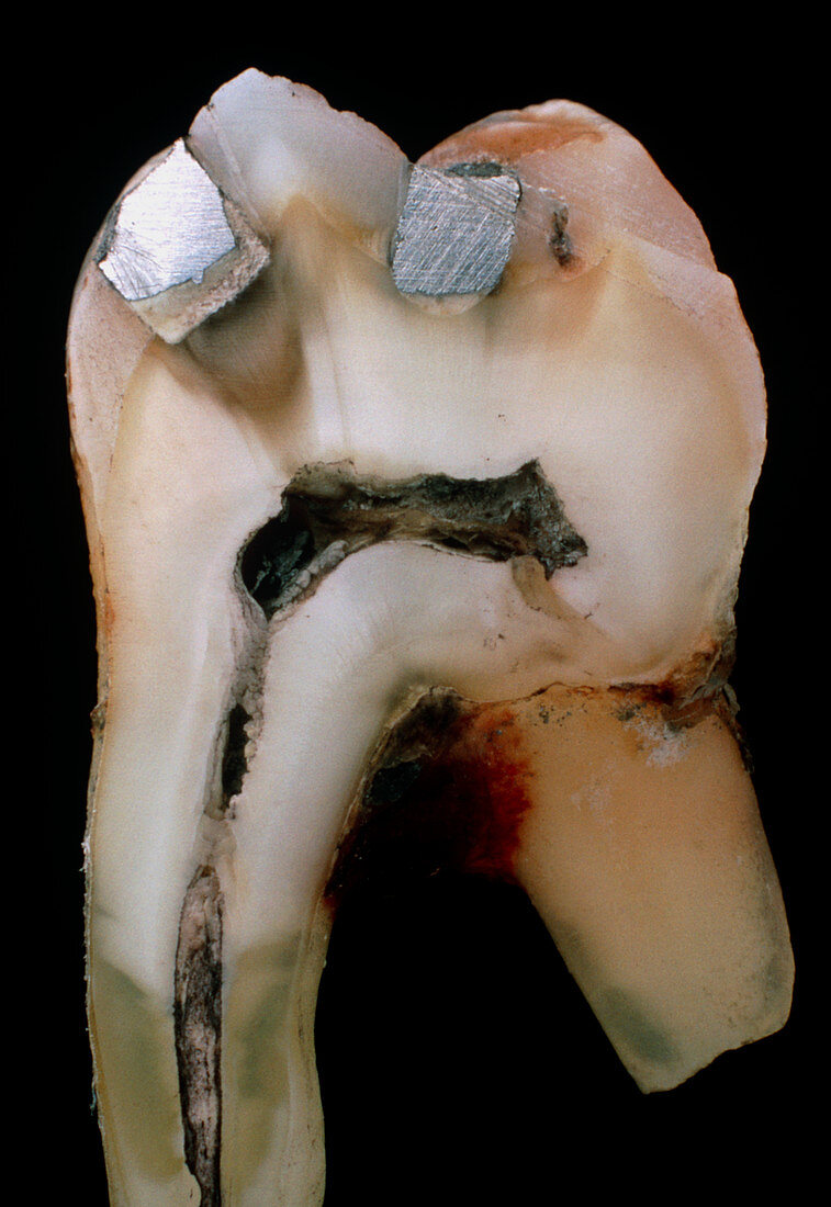Extracted molar