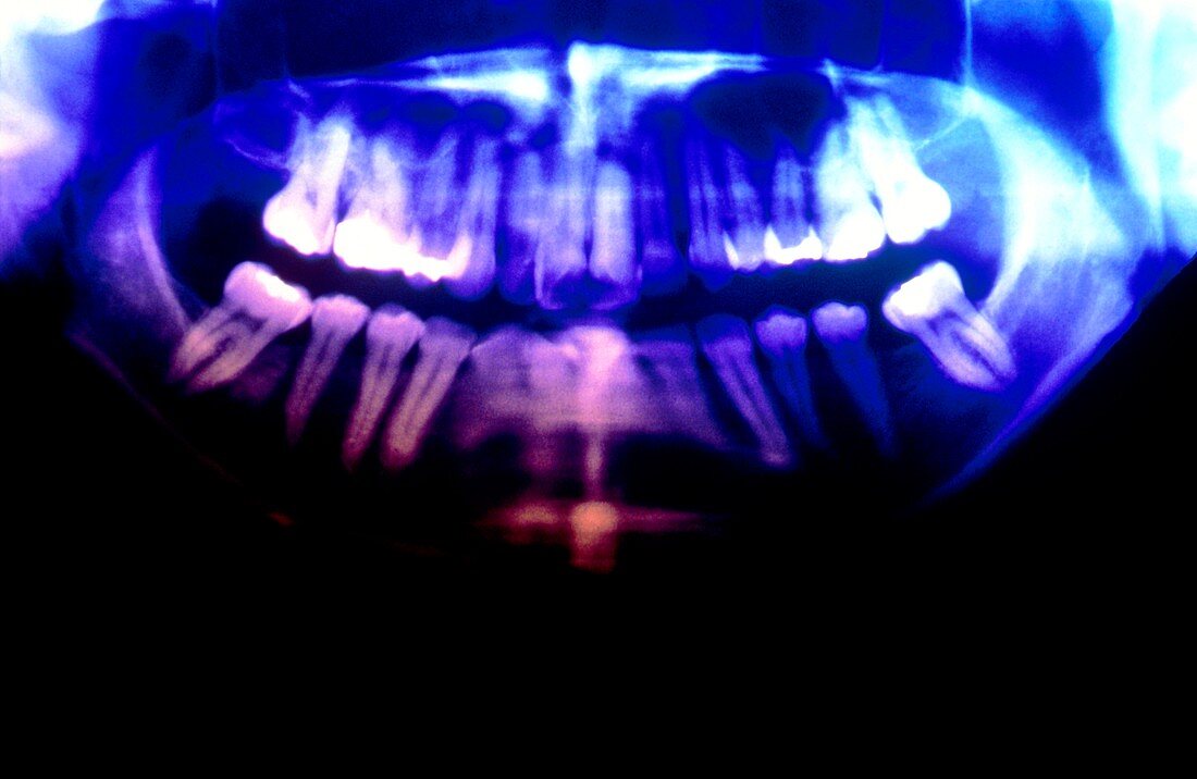 False-colour pan-oral X-ray showing fillings