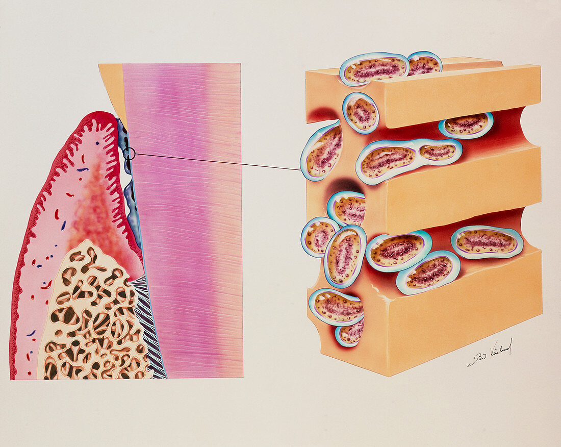 Artwork of bacterial plaque on a tooth neck