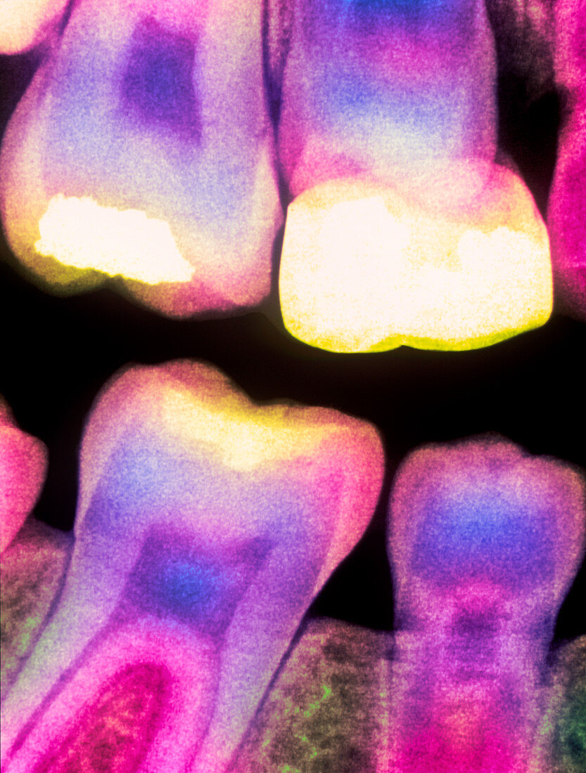 Colour X-ray of child's teeth with fillings/crown