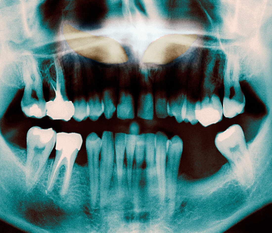 Impacted incisors,X-ray