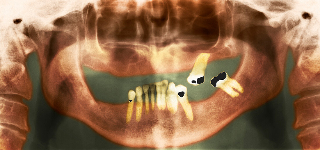 Loss of teeth,X-ray