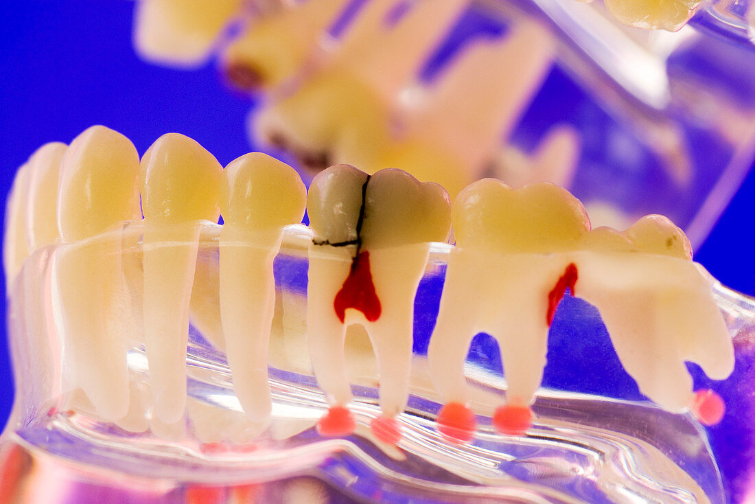 Tooth disorders,dental model
