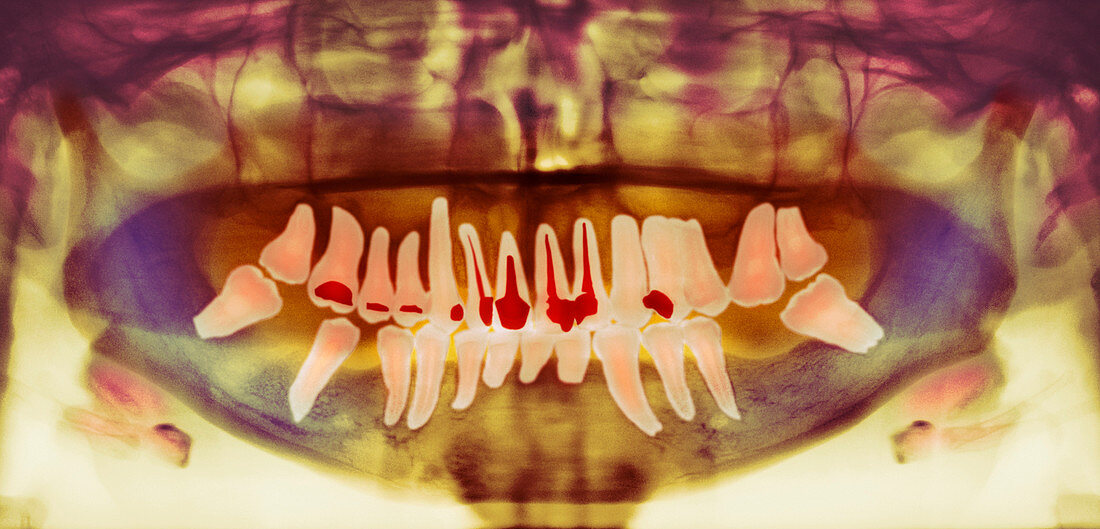 Root-canal treatment,dental X-ray