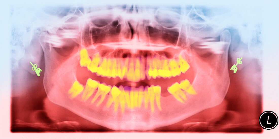 Missing teeth,X-ray