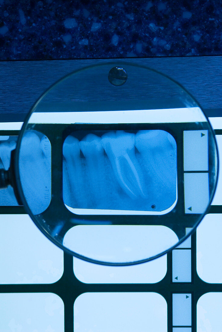 Root canal dental X-ray