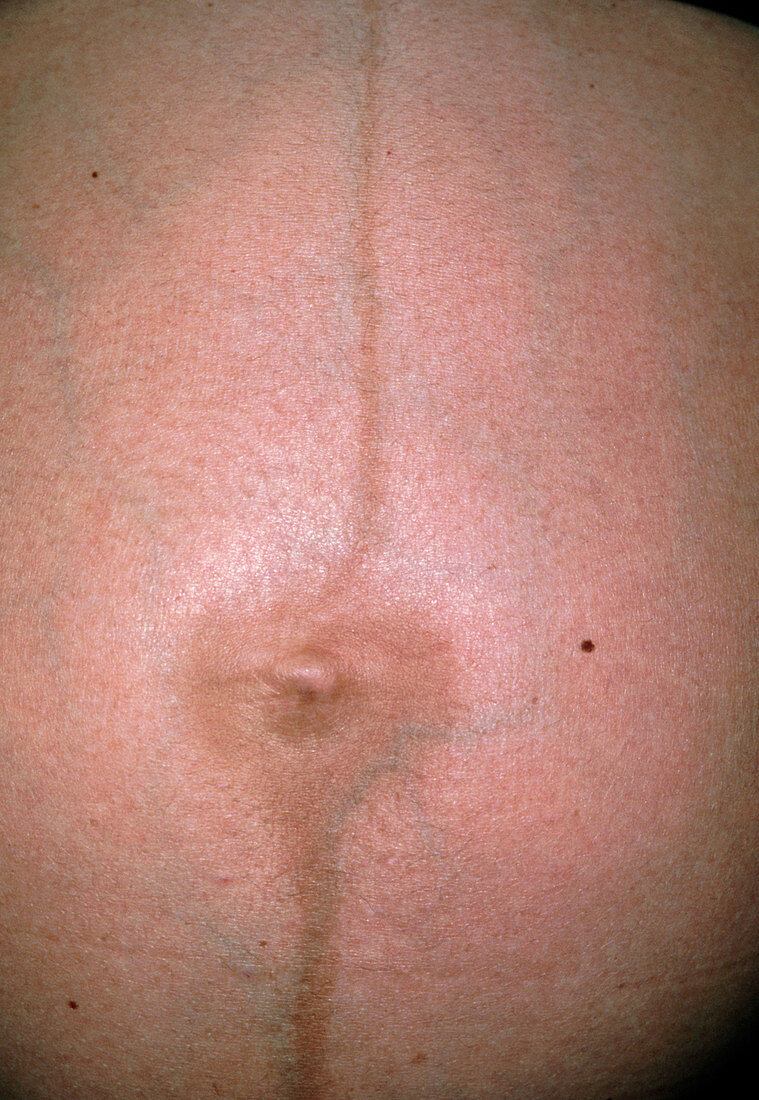 Line (linea negra) on pregnant woman's stomach