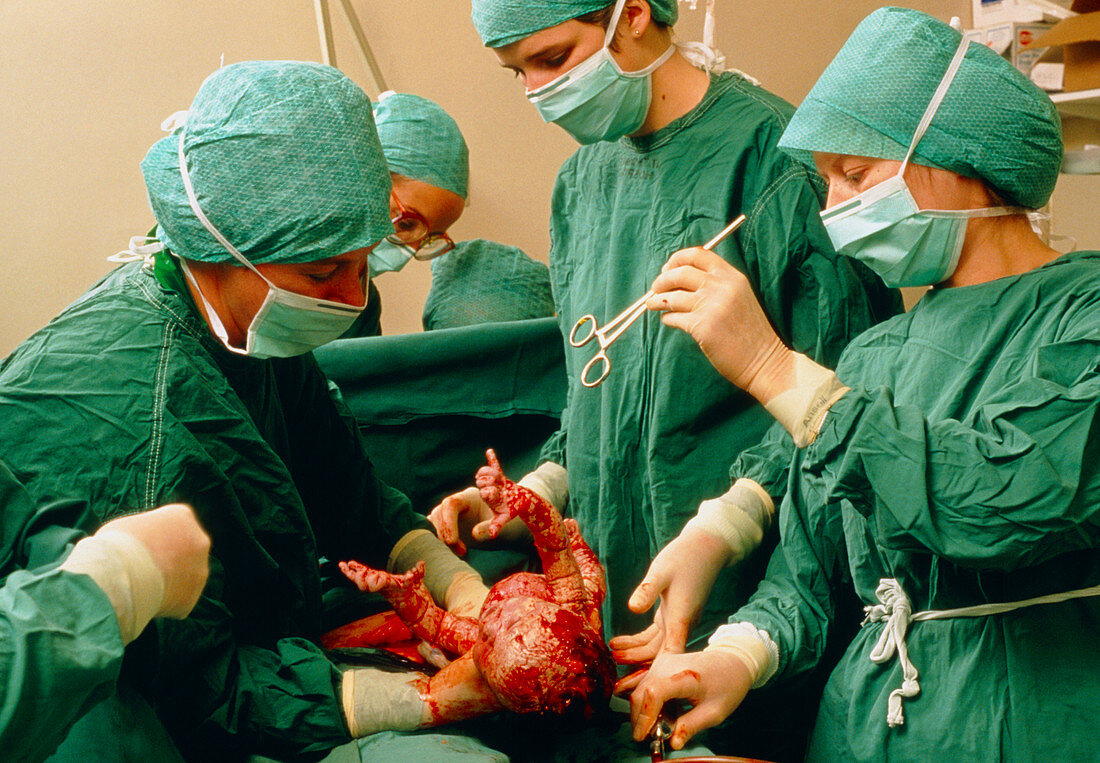 Surgeons extracting a baby in a caesarean delivery