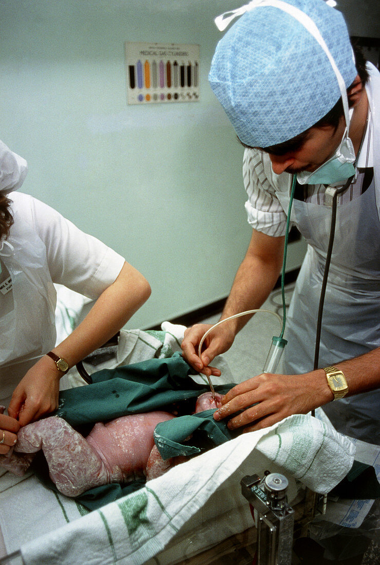 Newborn caesarean baby being aspirated