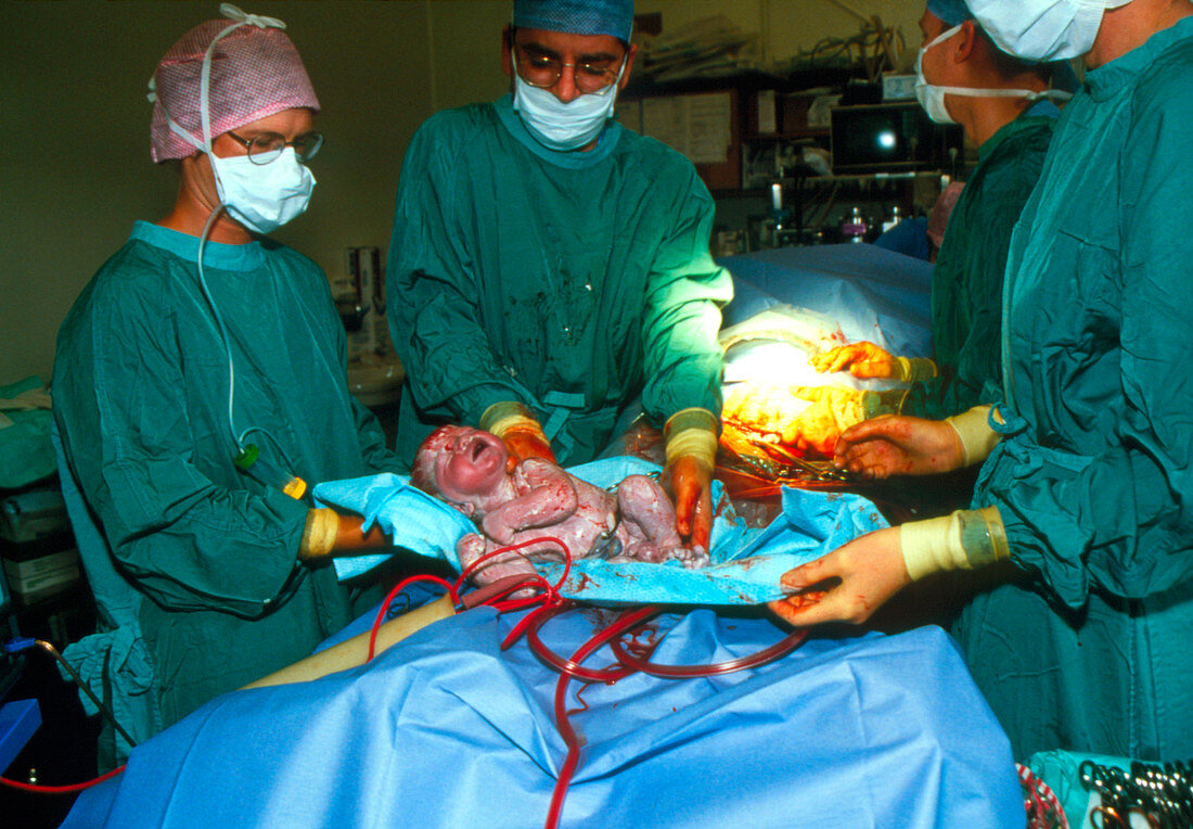 Newborn baby following a caesarean section birth
