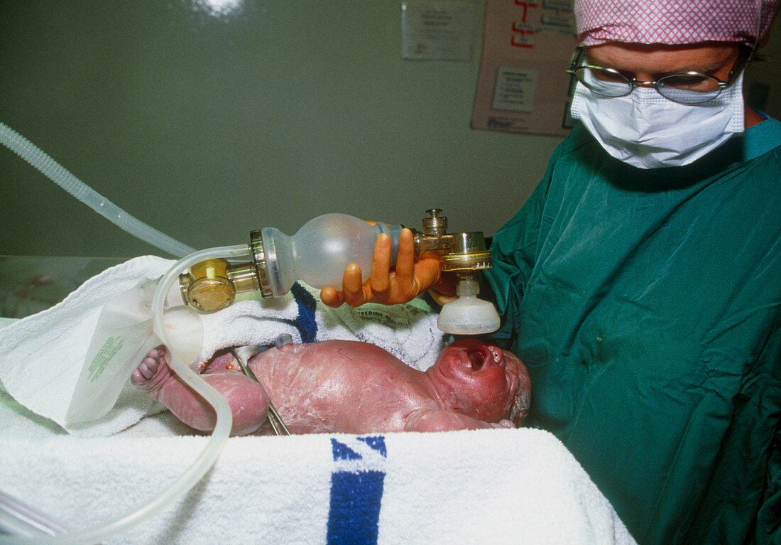 Caesarean baby being given oxygen through a mask