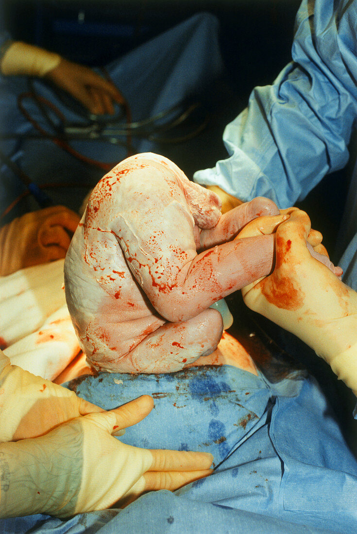 Caesarean birth