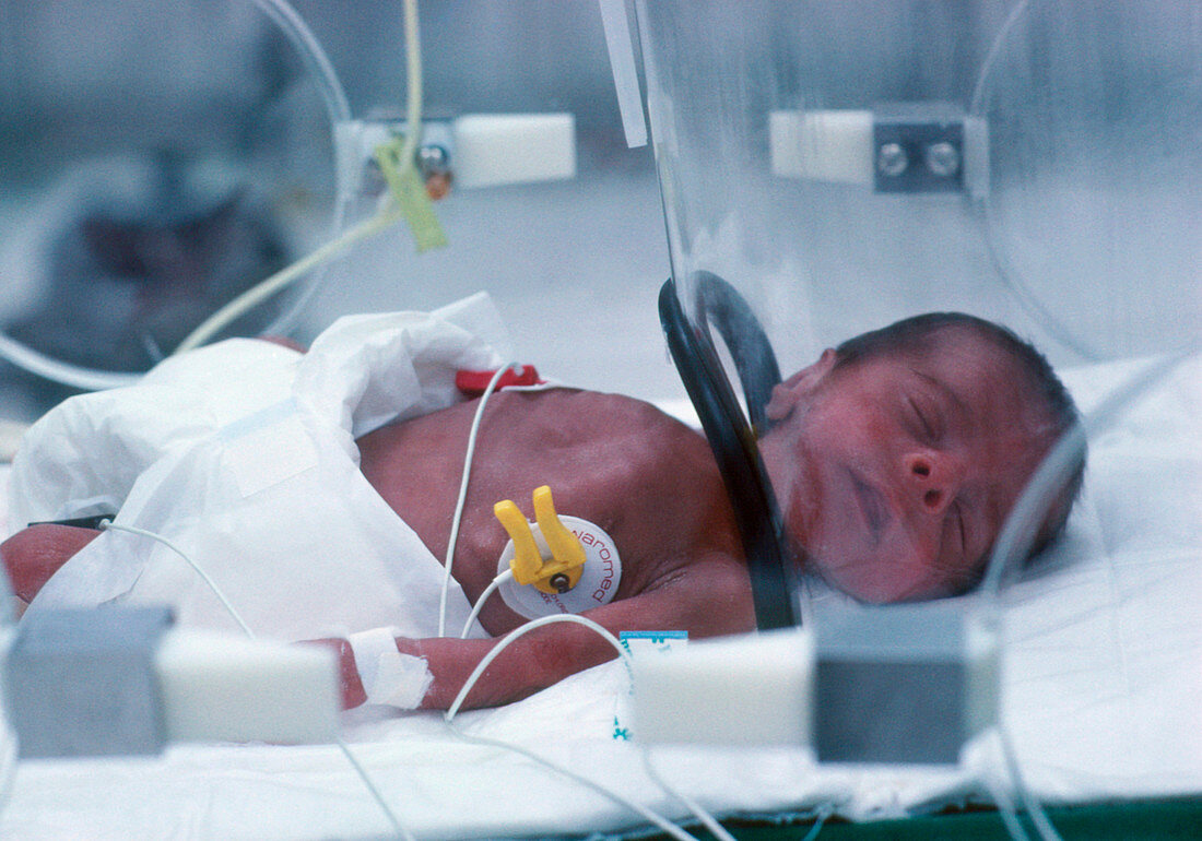 Neonatal baby receiving intensive care