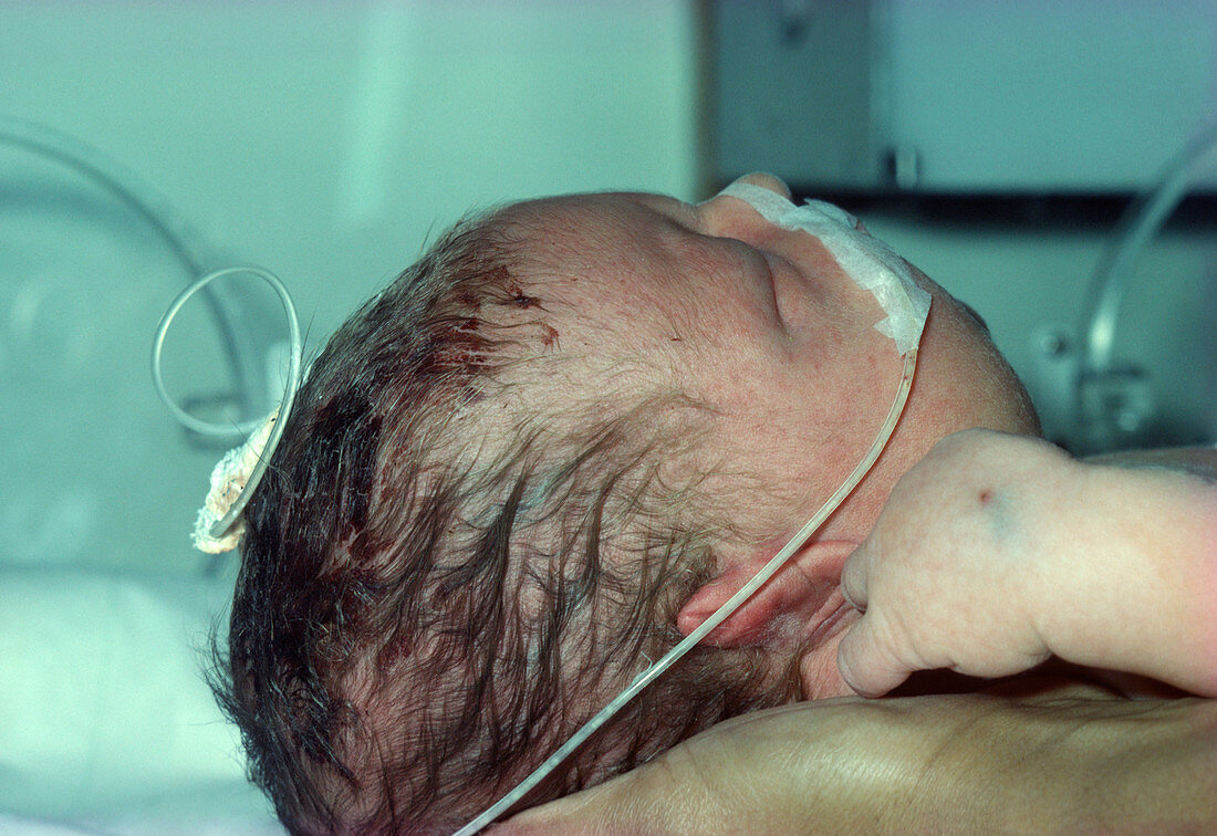 Newborn infant suffering from hydrops foetalis