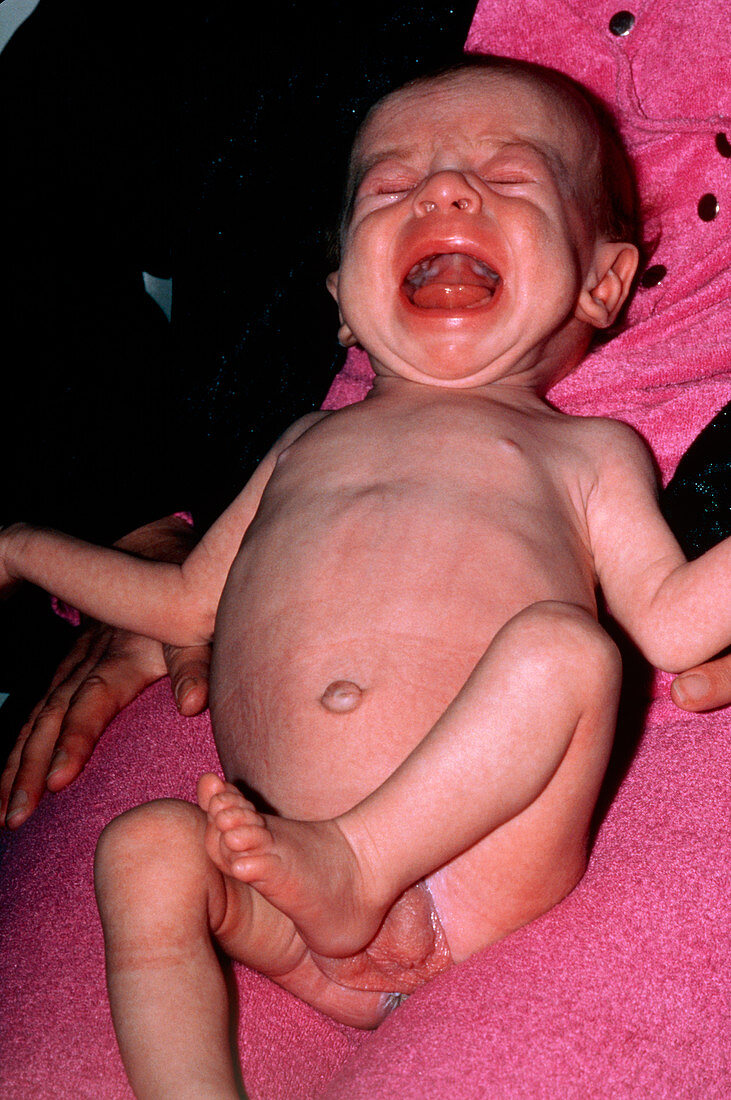 Failure to thrive disorder in 4-month old baby