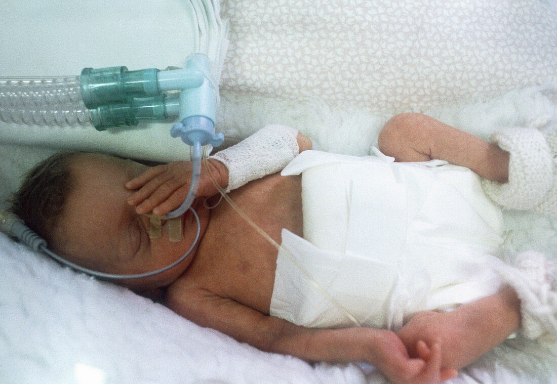 Premature baby in incubator with respirator