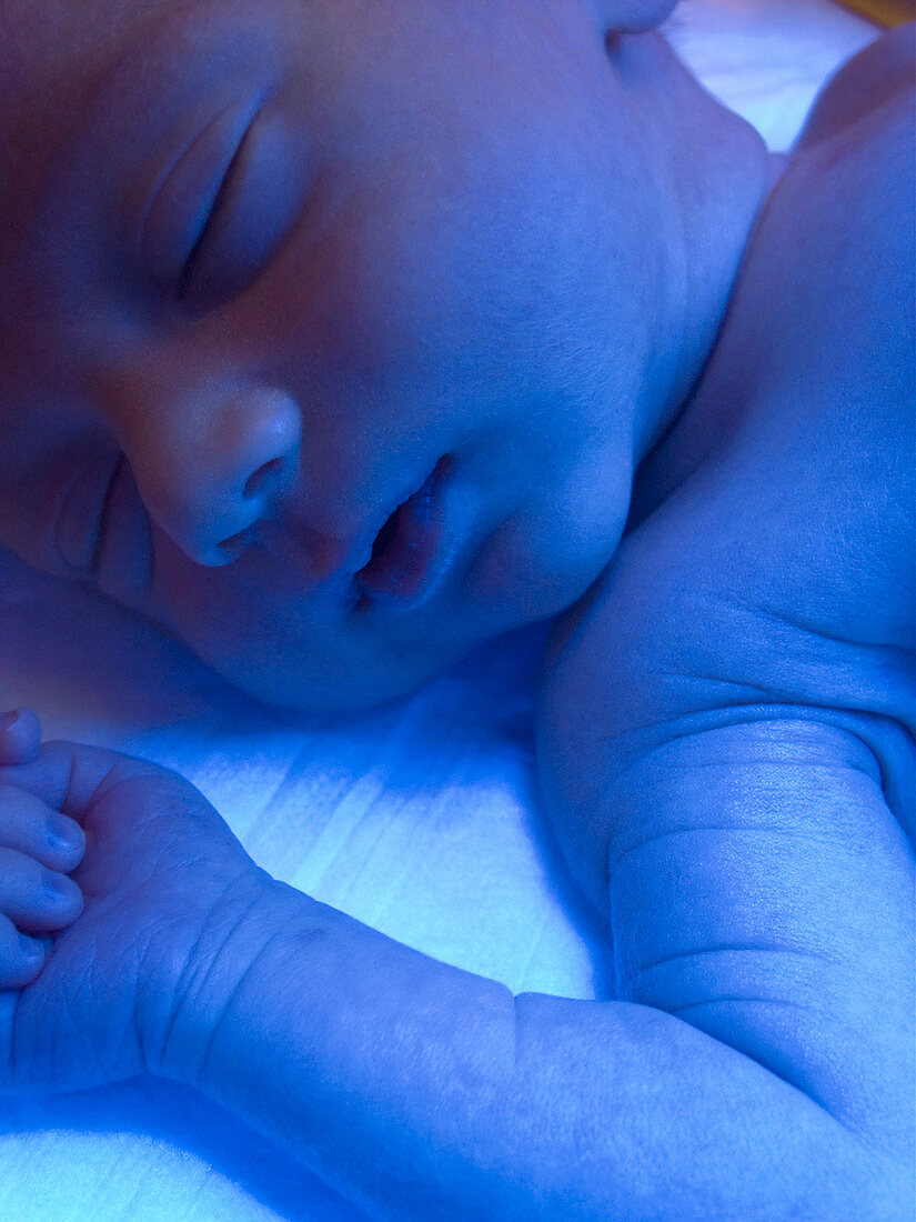 Neonatal jaundice light treatment