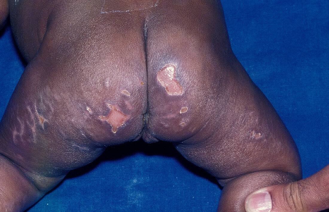 Syphilis skin lesions
