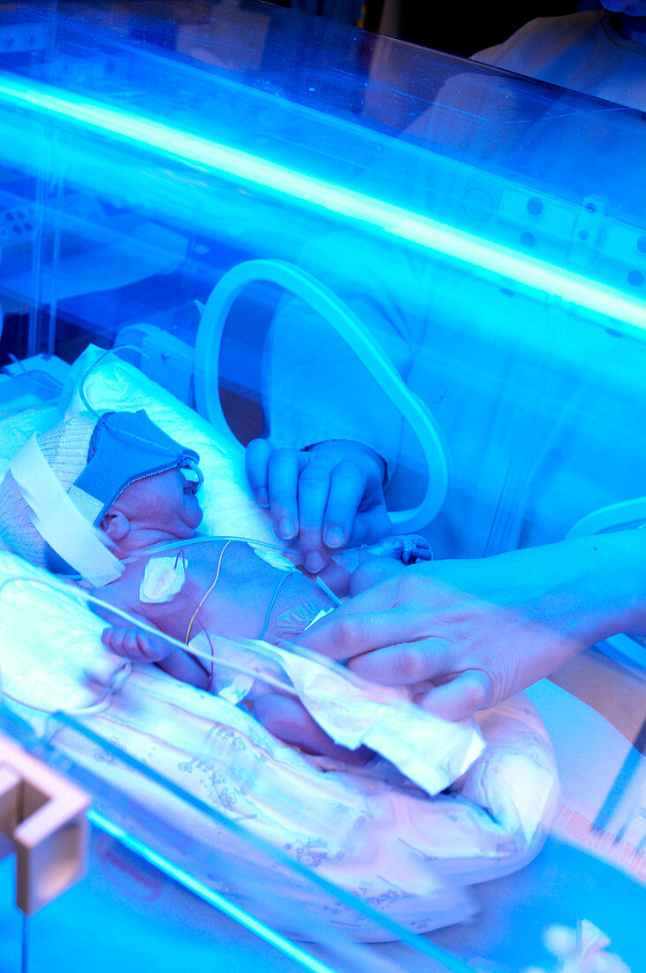 Premature baby receiving phototherapy