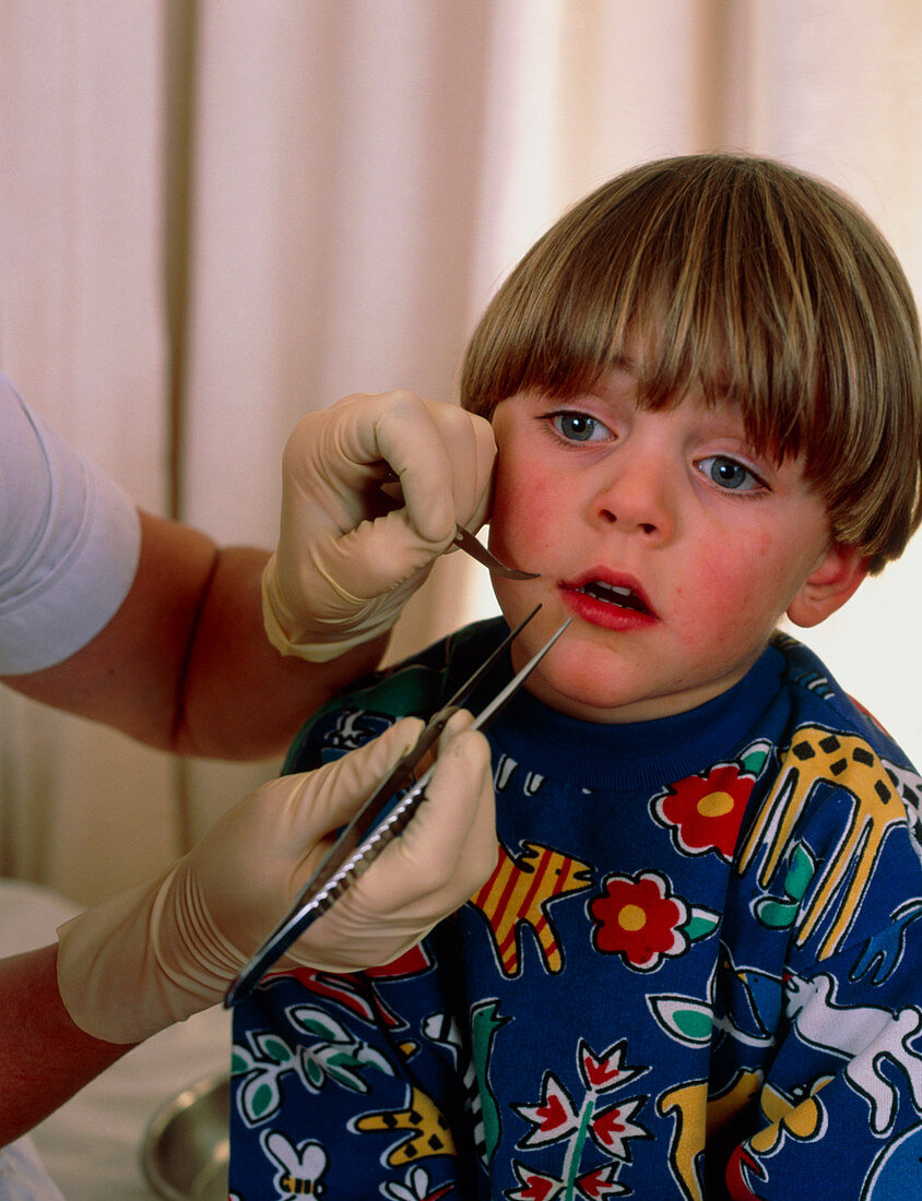 3 year old boy has a suture removed from his lip