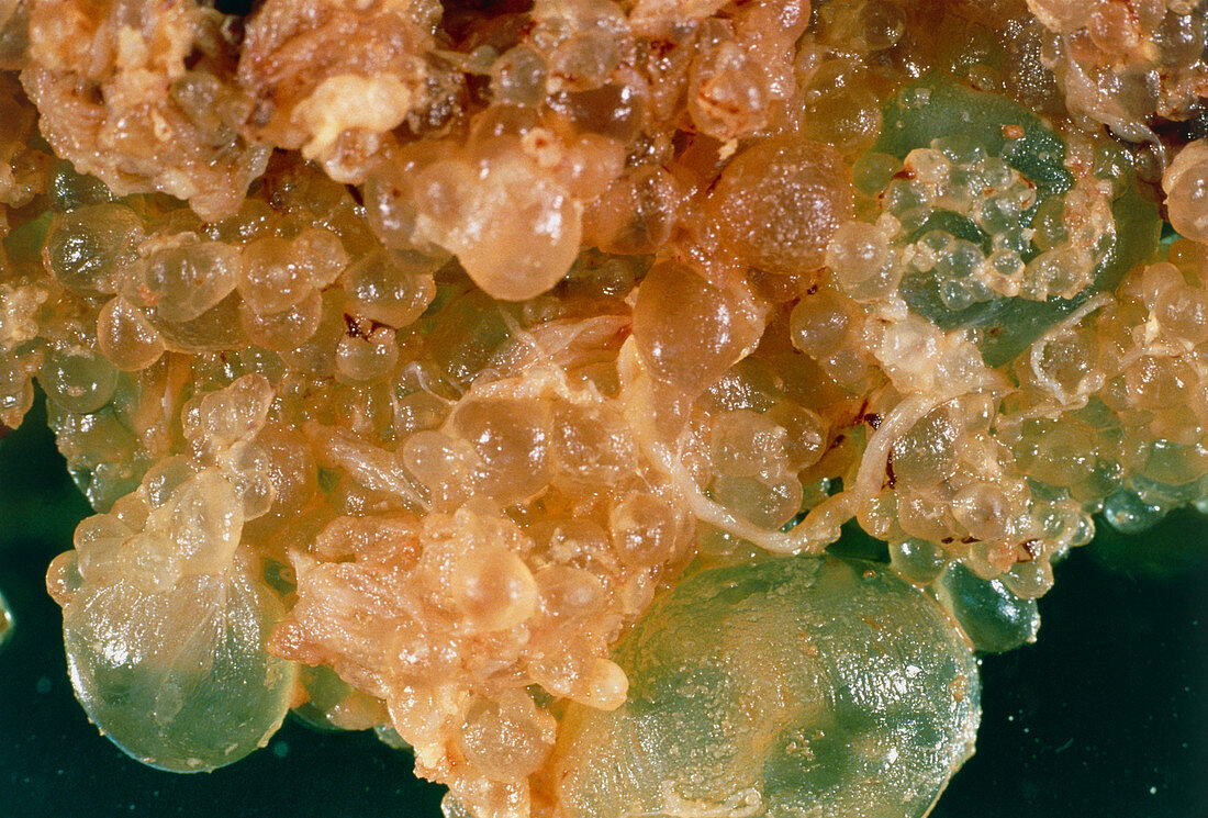 Gross specimen of hydatiform mole from placenta