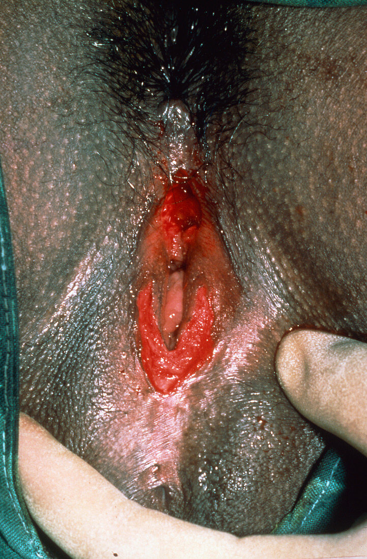 Re-opening circumcised vagina