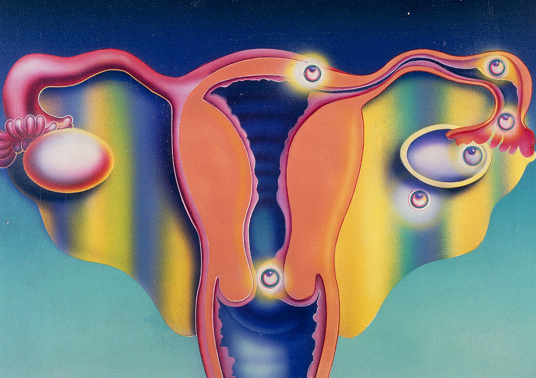 Artwork of a uterus showing ectopic pregnancies