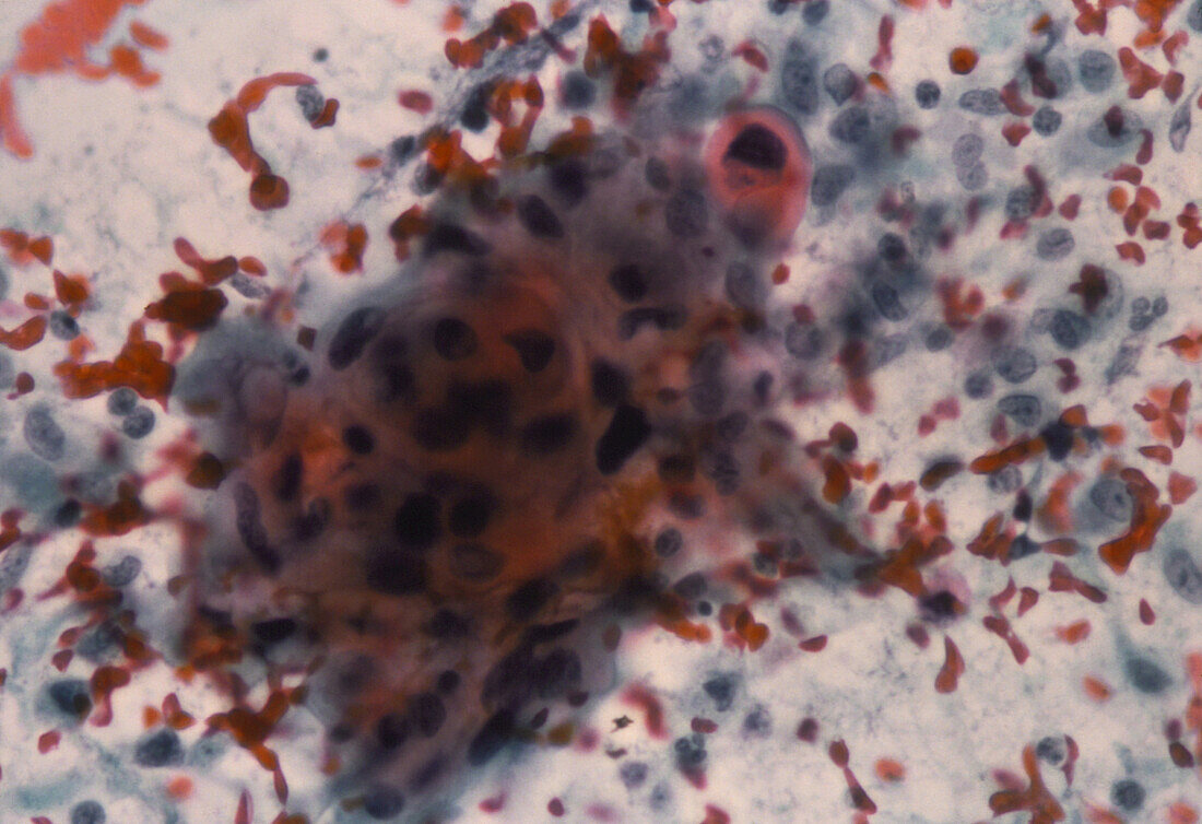 LM of cervical smear showing squamous carcinoma