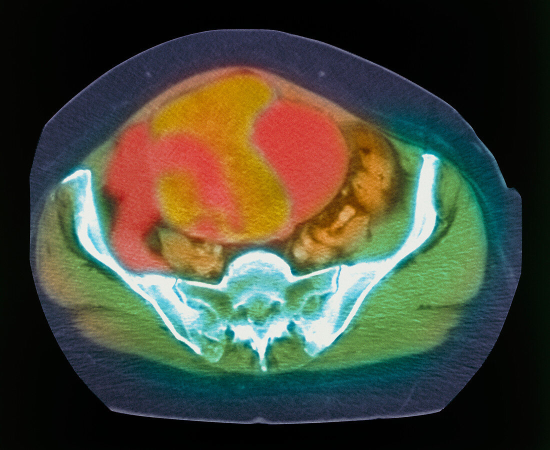 Coloured MRI scan of ovarian cancer