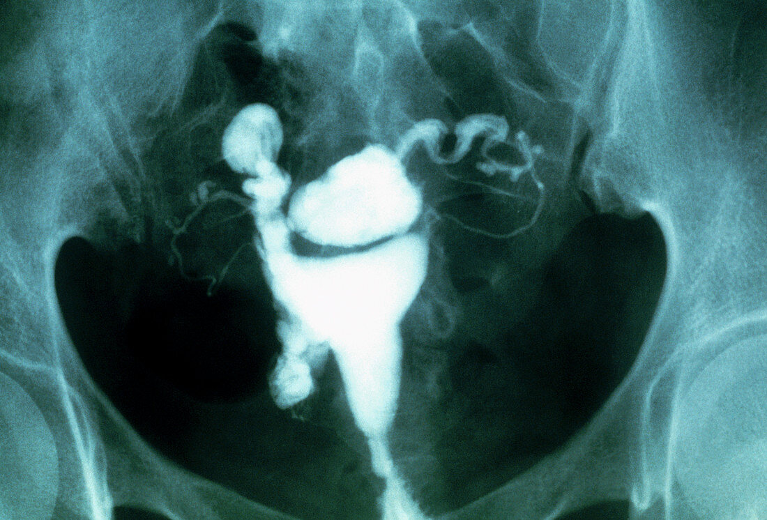 Endometriosis,X-ray