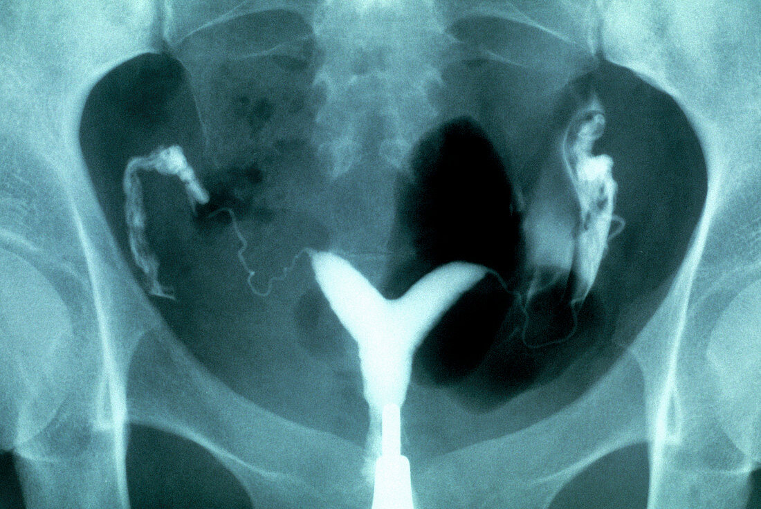 Two-horned uterus,X-ray
