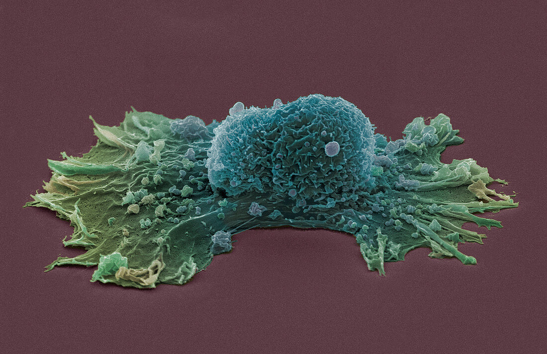 Ovarian cancer cell,SEM