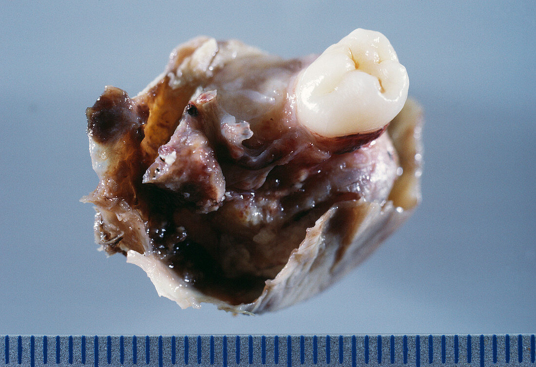 Dermoid cyst of the ovary