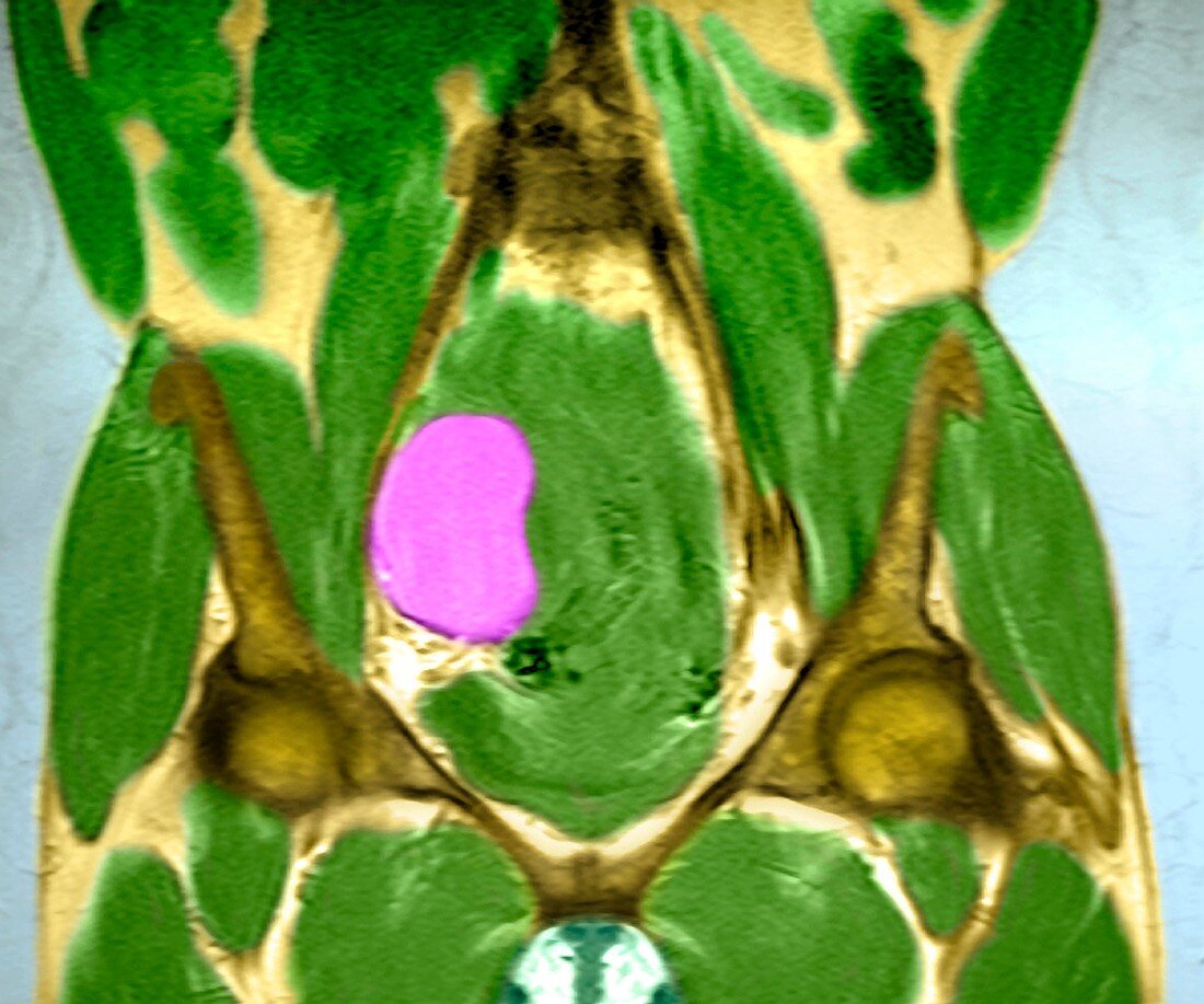 Uterine fibroid,MRI scan