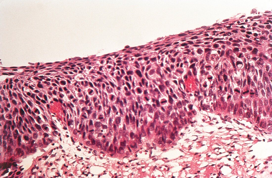 LM of biopsy section through human cervix