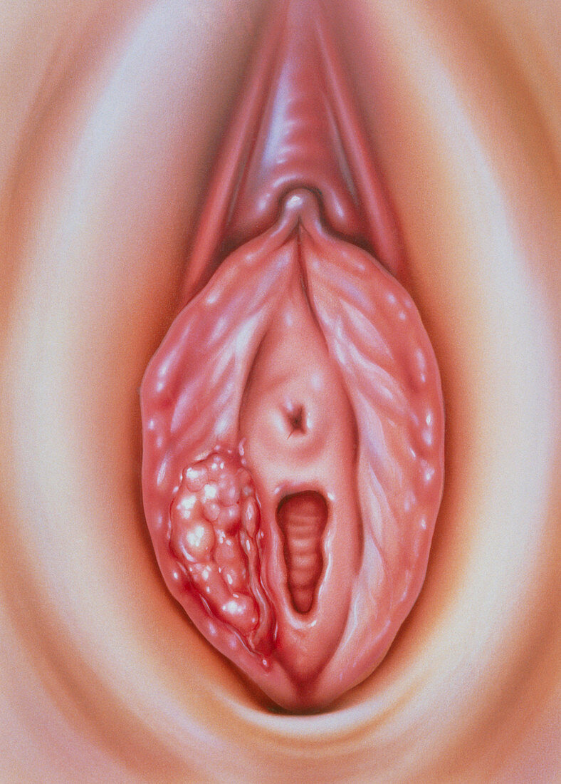 Illustration of carcinoma of the external vagina