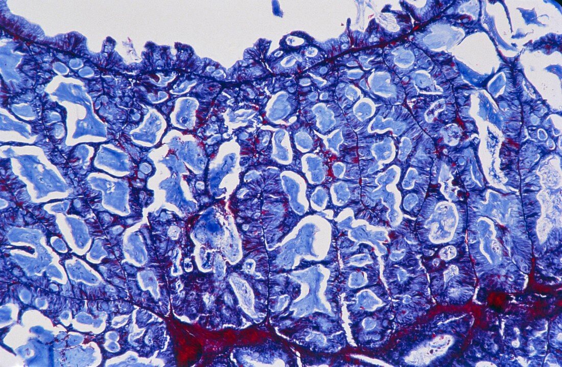 Light micrograph of an ovarian cystadenoma