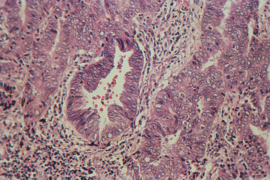 LM showing human endometrial adenocarcinoma