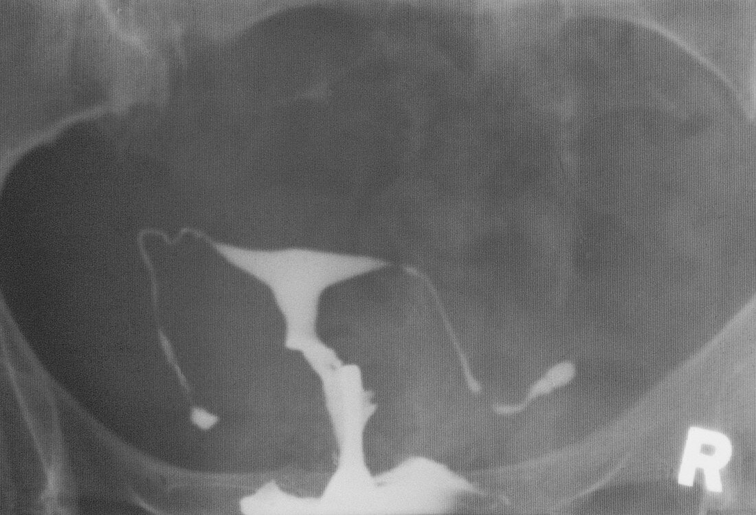 X-ray of blocked Falloppian tubes