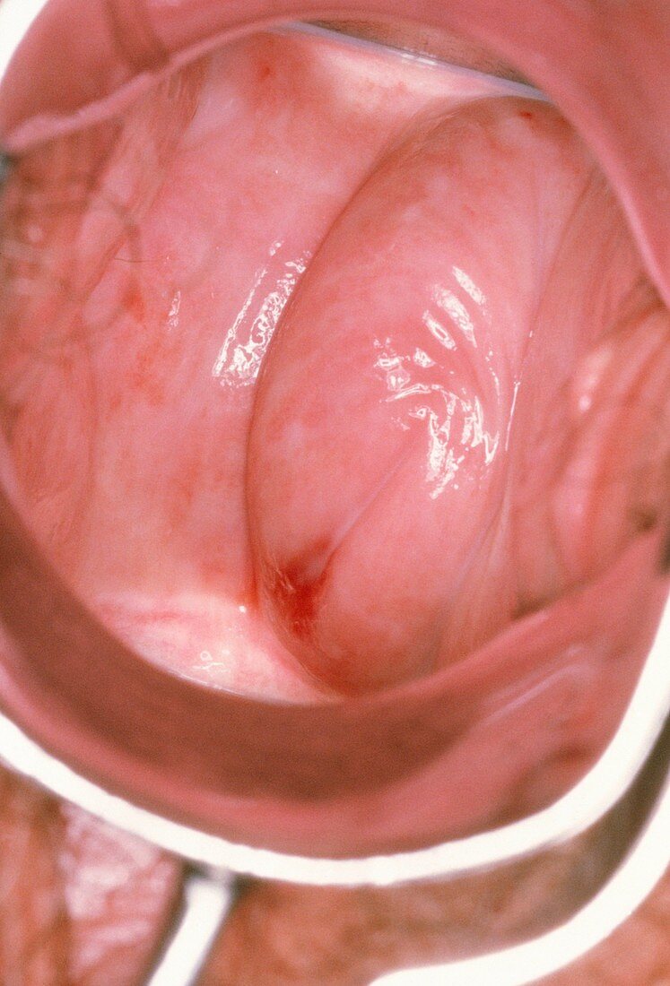 Colposcope image showing vulvo-vaginitis