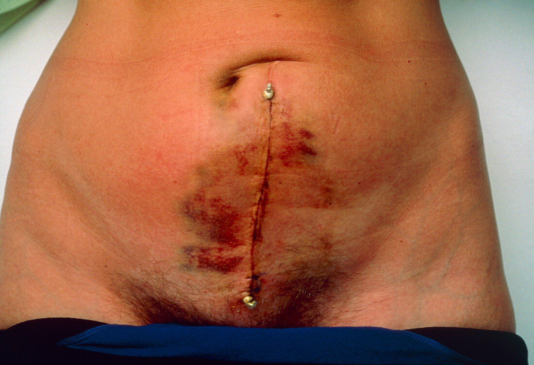Abdominal scar in woman after womb-cancer surgery