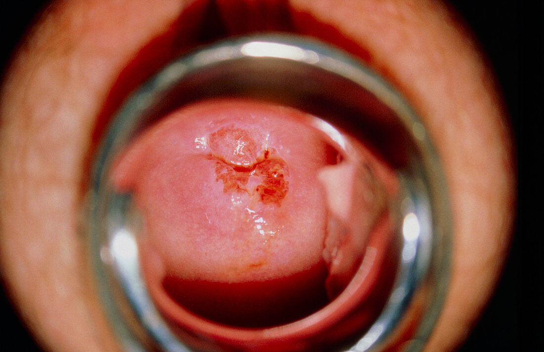 View of a cervix with mild (CIN 1) dysplasia