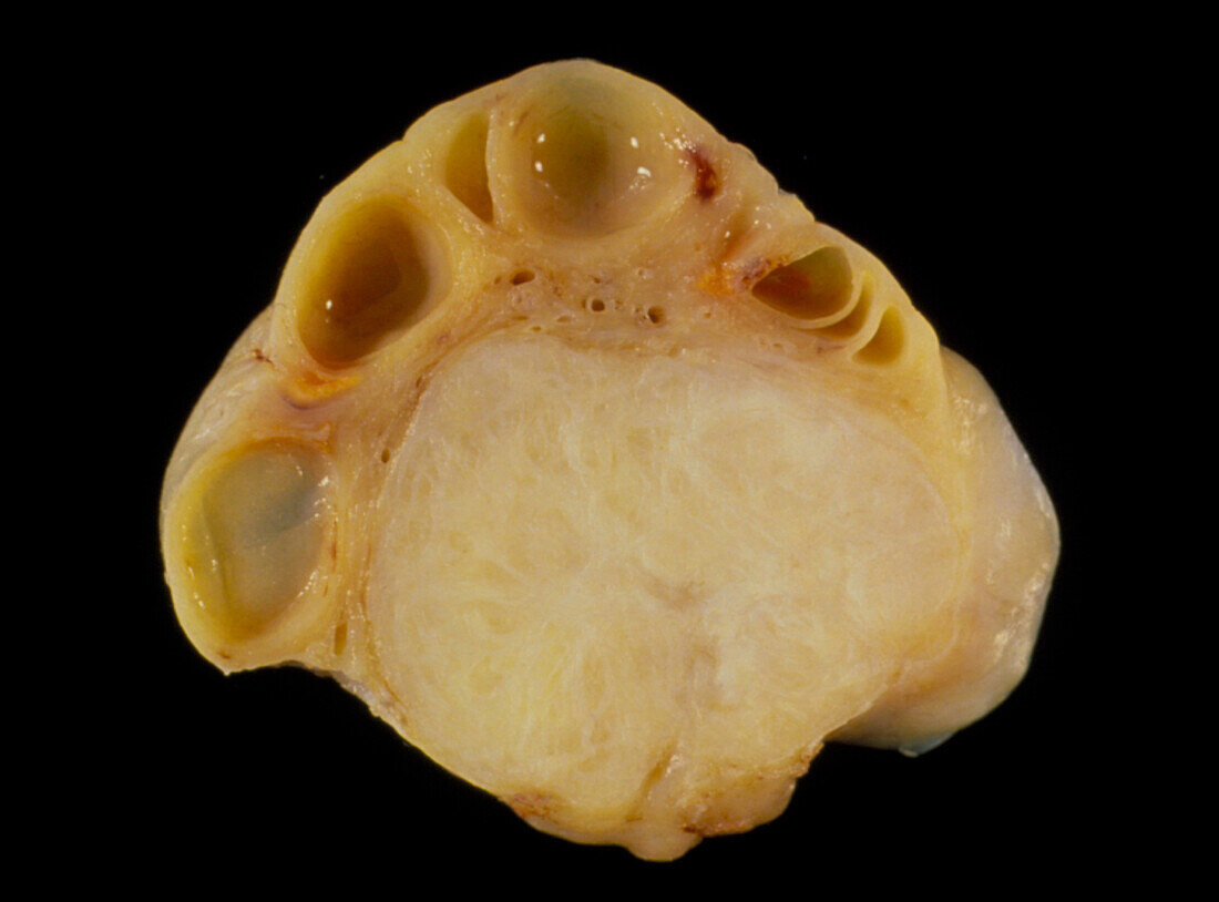 Ovary with leiomyoma and benign follicular cysts