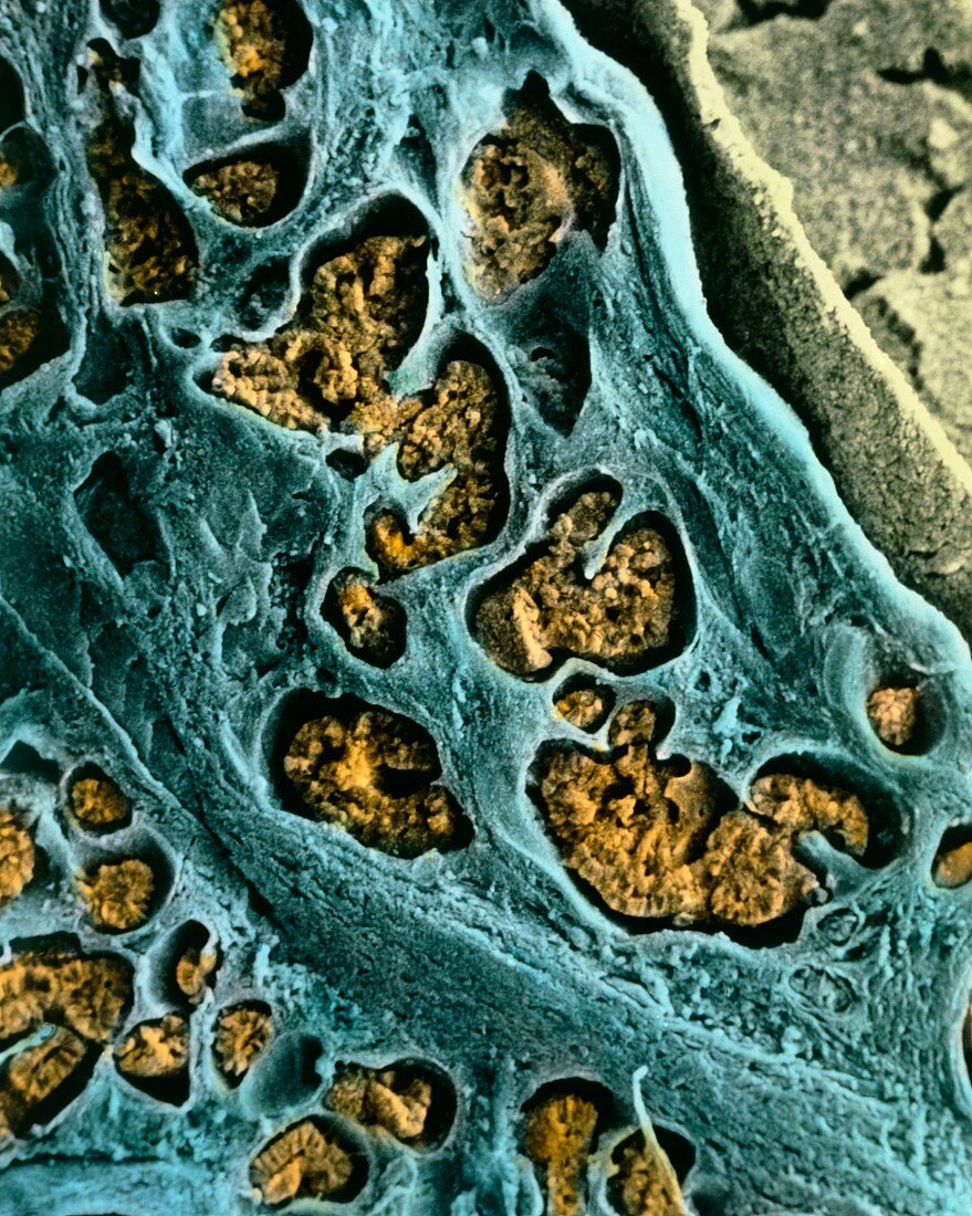 Coloured SEM of Sertoli-Leydig tumour in ovary