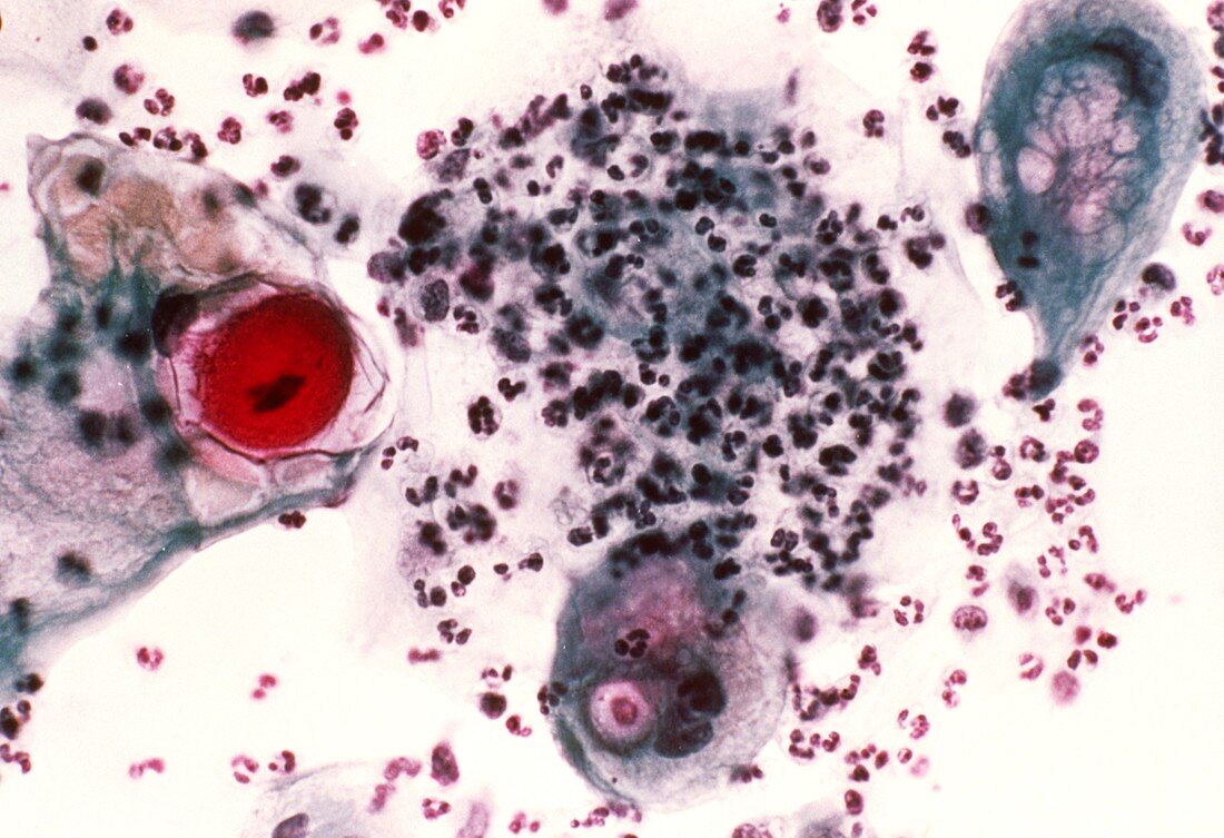 LM of cervical smear showing effects of radiation