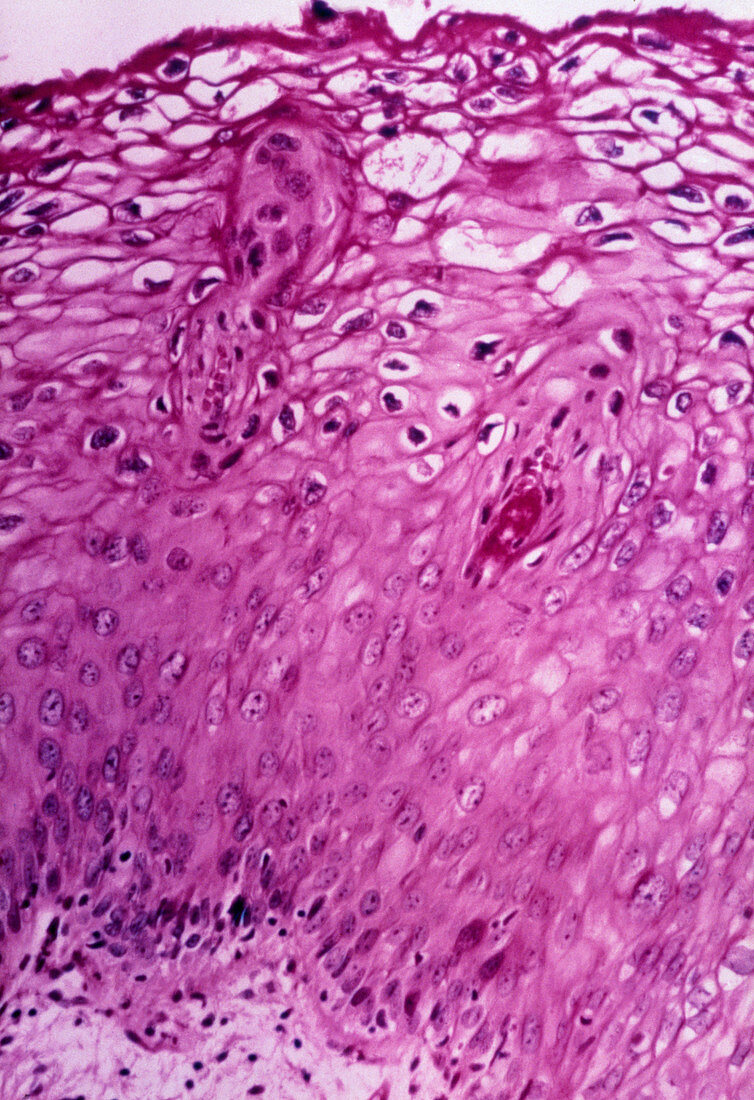LM of section of cervix revealing HPV infection